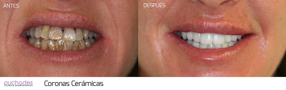 Coronas cerámicas, caso 1: antes y después