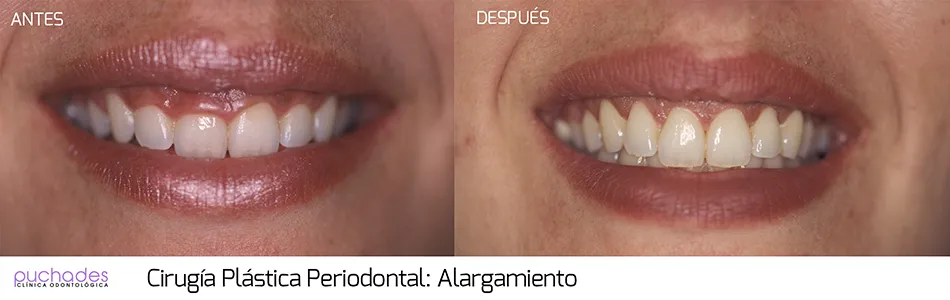 Cirugía plástica periodontal, caso 5: antes y después