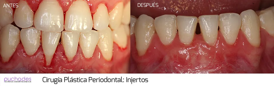 Cirugía plástica periodontal, caso 2: antes y después