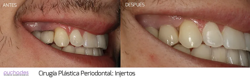 Cirugía plástica periodontal, caso 4: antes y después