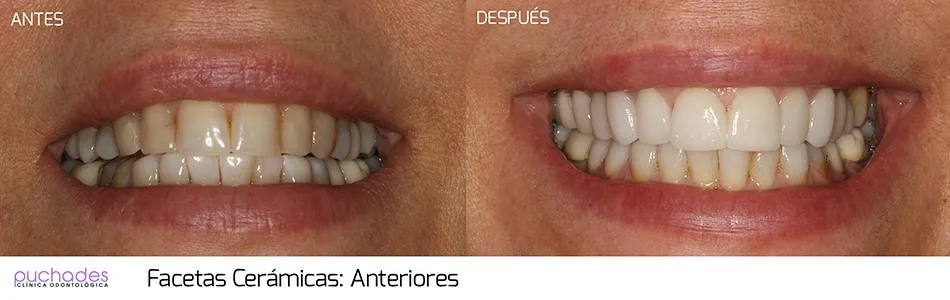 Porcelain veneers, case 1: before and after