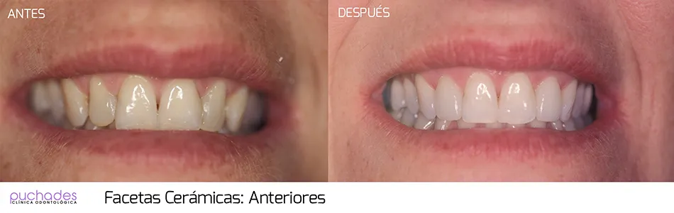 Porcelain veneers, case 2: before and after