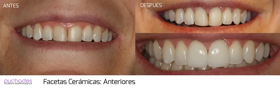 Porcelain veneers, case 3: before and after