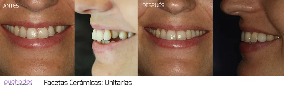 Facetas cerámicas, caso 4: antes y después