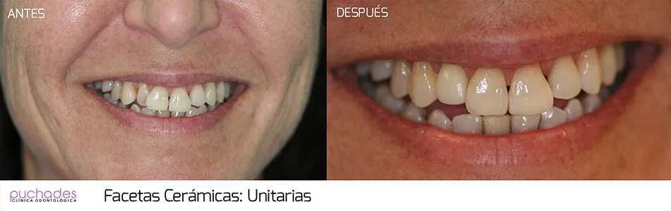 Facetas cerámicas, caso 5: antes y después
