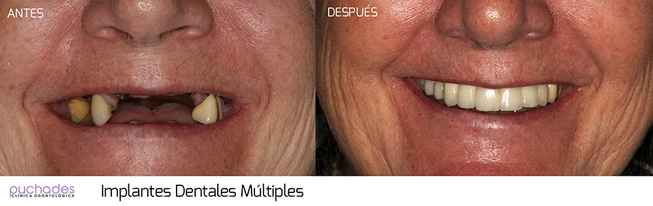 Implantes dentales, caso 4: antes y después