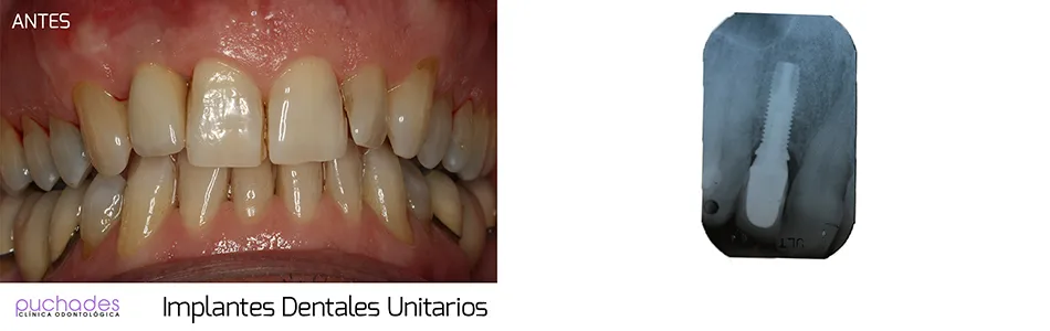 Implantes dentales, caso 2: antes y después