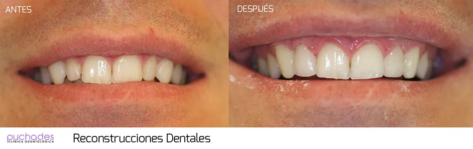 Reconstrucciones dentales, caso 2: antes y después