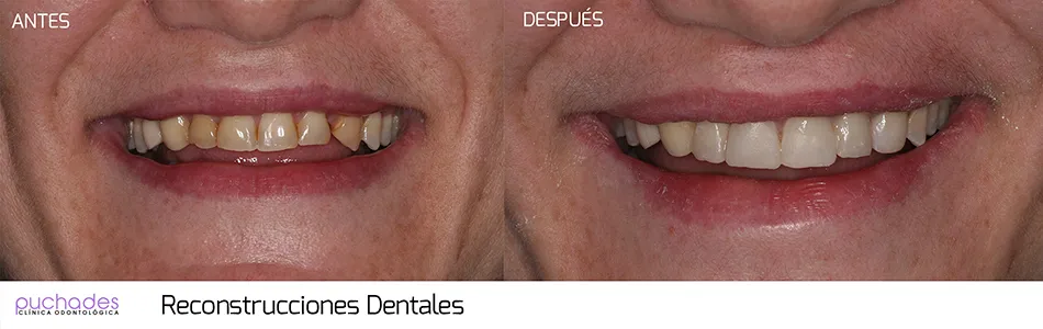 Reconstrucciones dentales, caso 3: antes y después