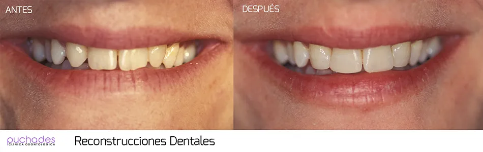 Reconstrucciones dentales, caso 1: antes y después