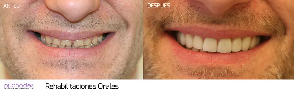 Rehabilitaciones orales, caso 1: antes y después