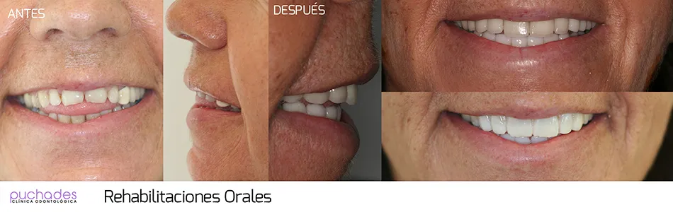 Rehabilitaciones orales, caso 3: antes y después